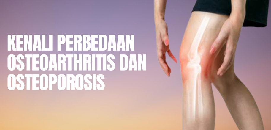 Kenali Perbedaan Osteoarthritis dan Osteoporosis
